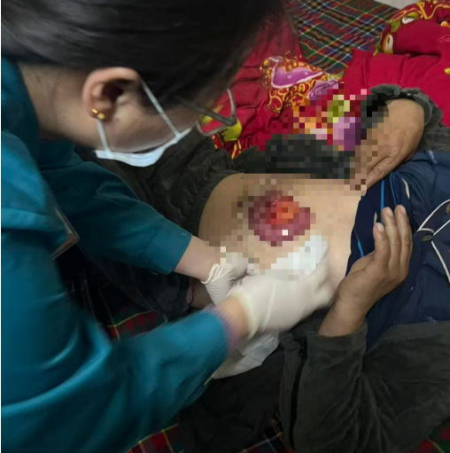 夜间紧急出诊：我院急诊团队妥善处理一例术后切口肠管脱出患者