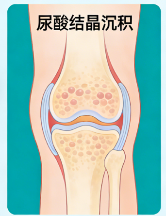 痛风——“帝王病”为何盯上普通人？