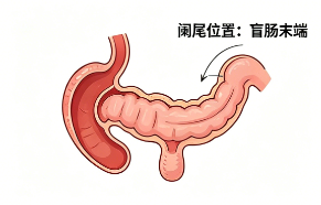 阑尾炎一定要开刀吗？普外科医生讲解腹腔镜微创技术