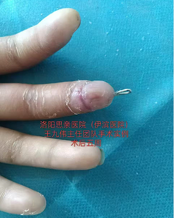 【手术案例】19岁女孩左手中指末节离断，思亲医院骨外科团队紧急再植成功