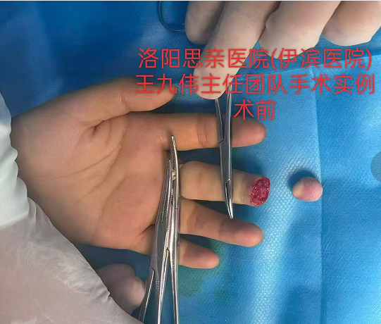 【手术案例】19岁女孩左手中指末节离断，思亲医院骨外科团队紧急再植成功